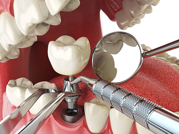 Best Emergency Cosmetic Dentistry (e.g., broken veneers) in Woodbridge, CA